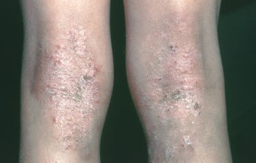 atopic_dermatitis_symptomos_knees